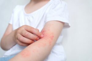 Older girl with rash on upper arm